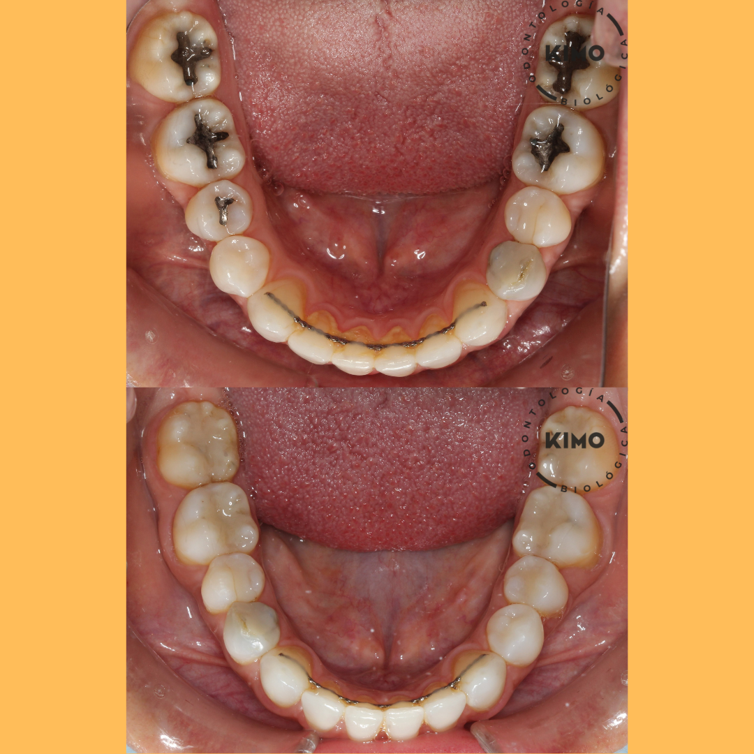 caso retirada de amalgama