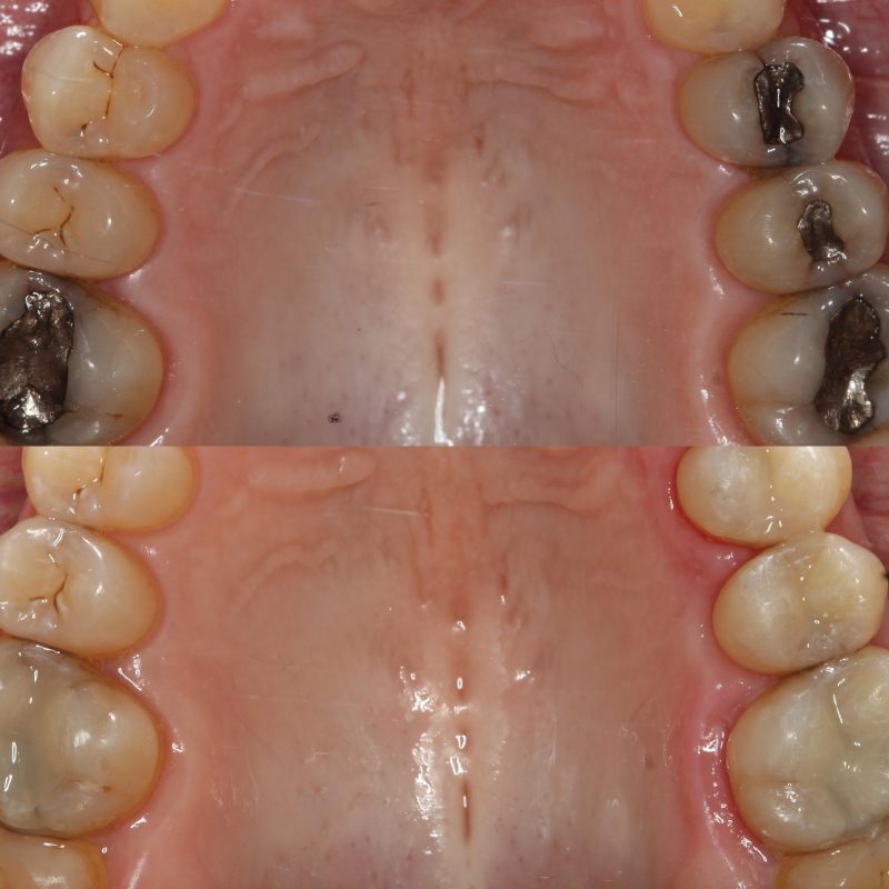 caso retirada de amalgama