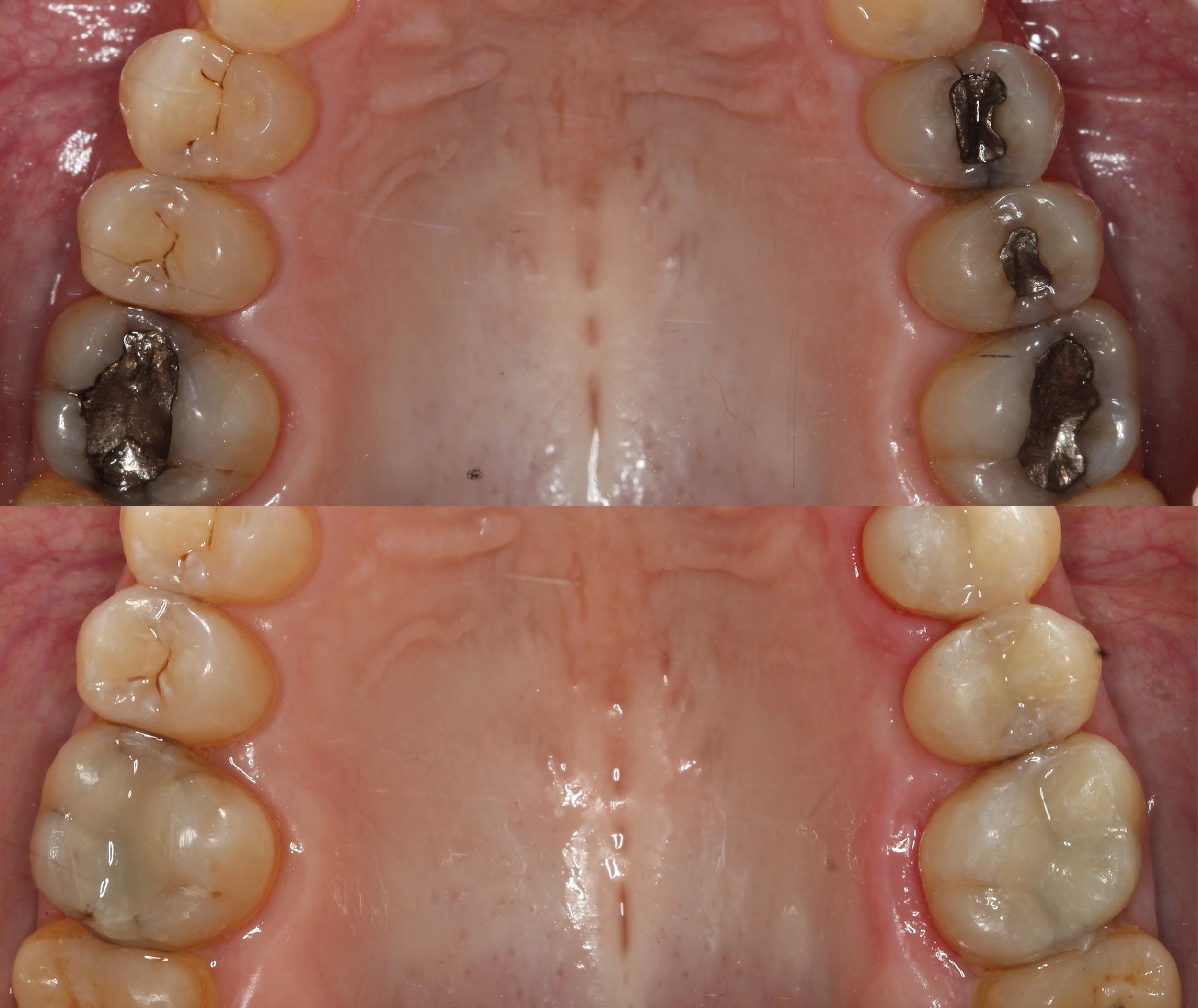 caso retirada de amalgama