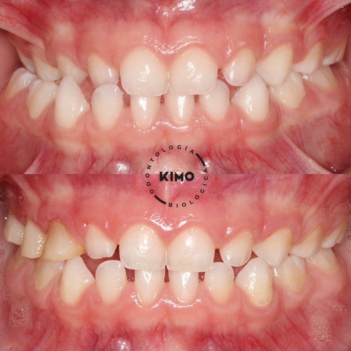 ortodoncia mordida cruzada