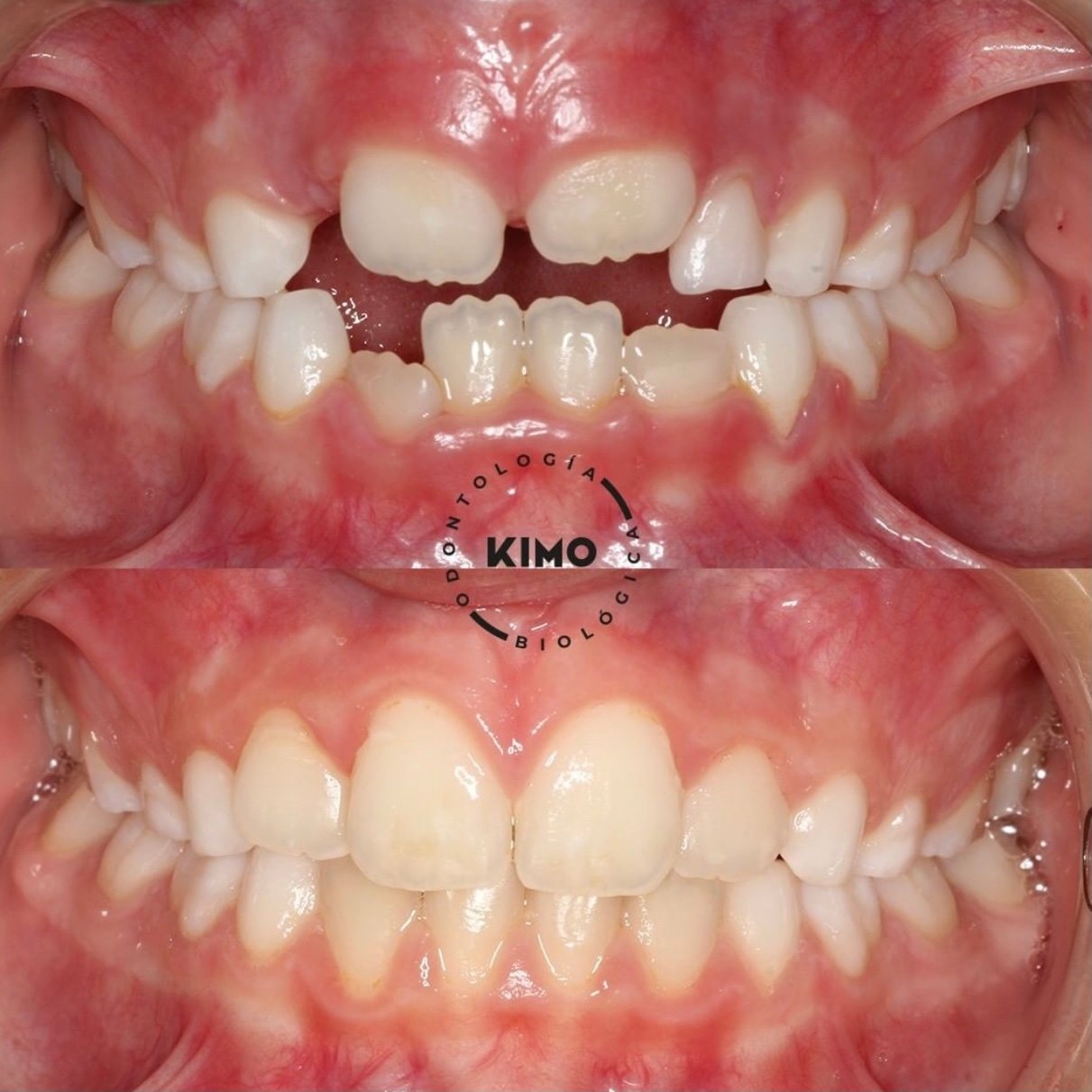 ortodoncia miofuncional
