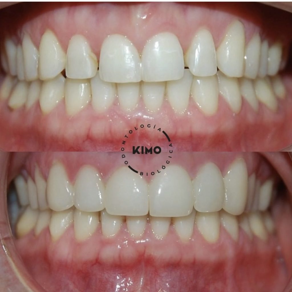 Antes y después de tratamiento con carillas biocompatibles en Valencia