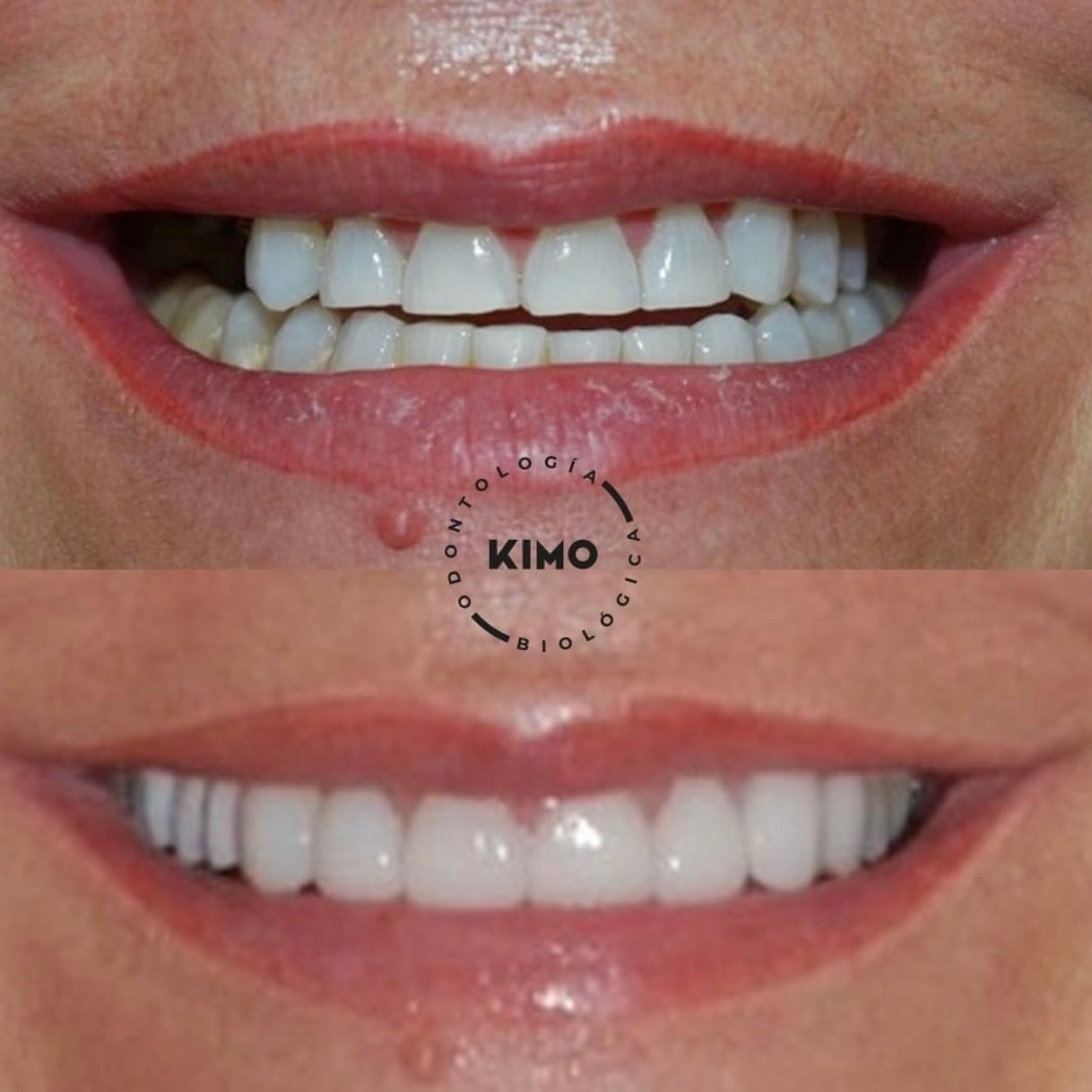 caso carillas lumineers