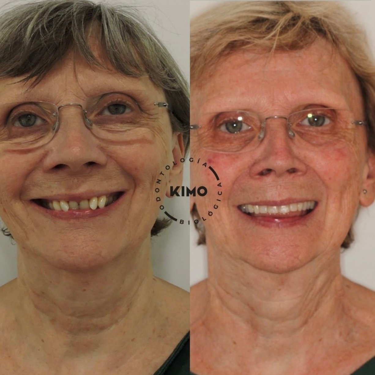 caso carillas lumineers