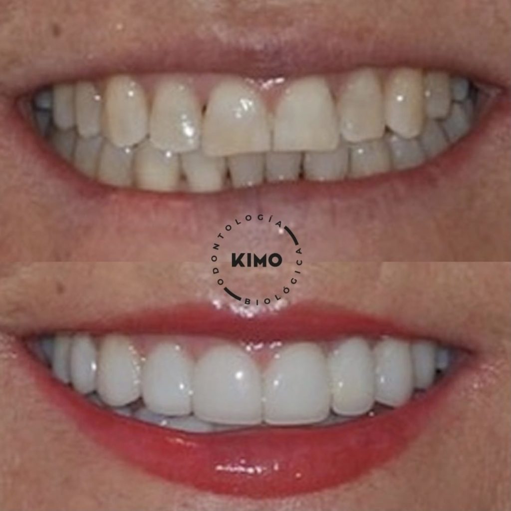 Antes y después de tratamiento con carillas dentales en Valencia