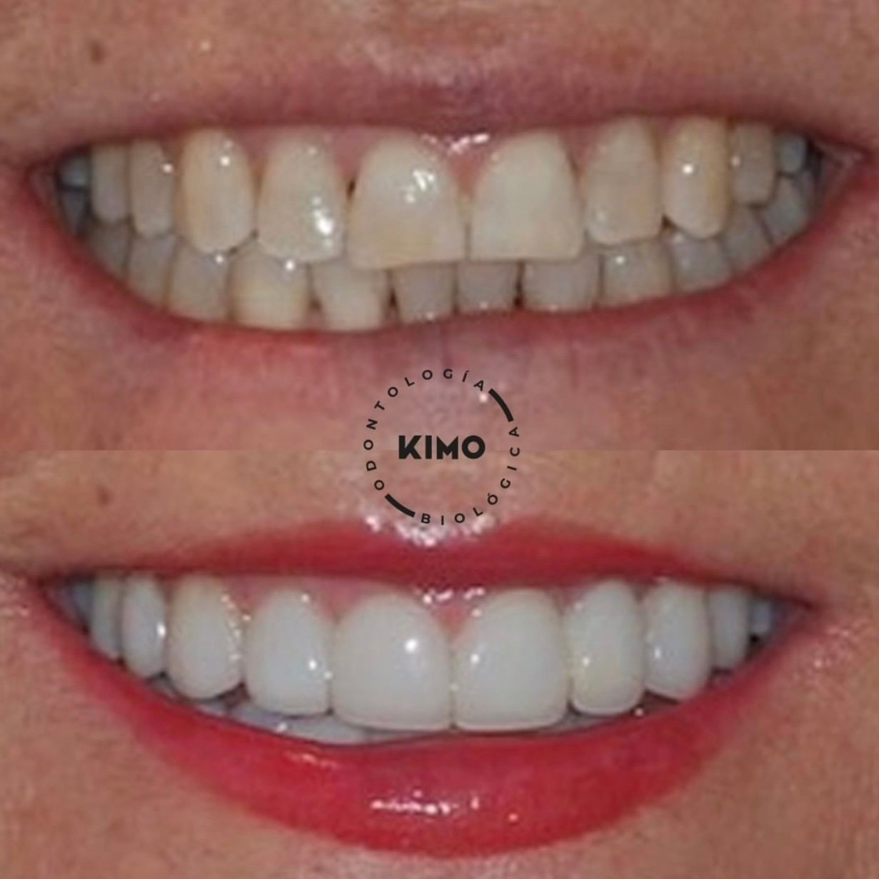 caso carillas lumineers