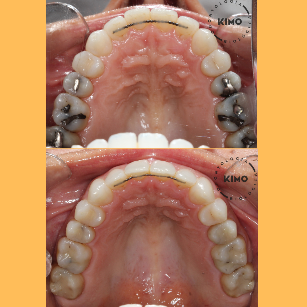 caso retirada de amalgama