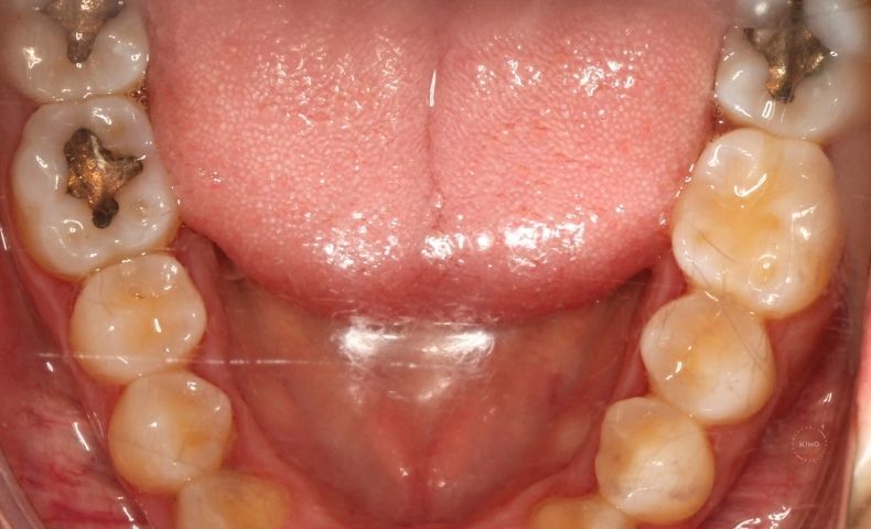 Cuándo cambiar un amalgama dental en KIMO Valencia