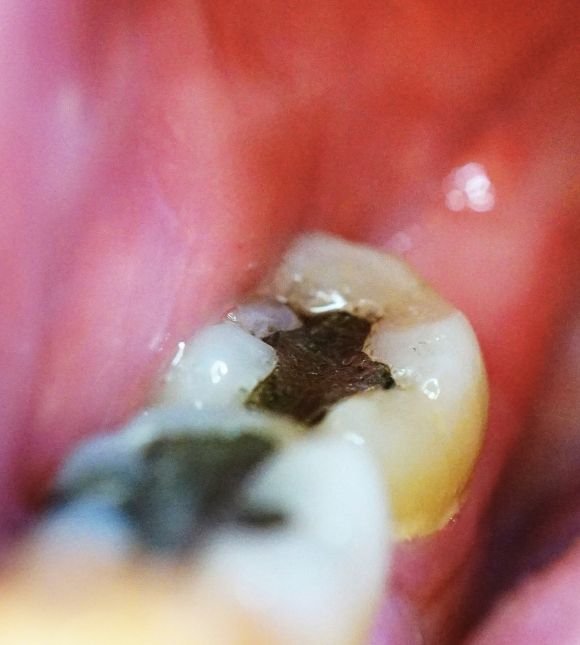 retirada-de-amalgama-en-valencia-clinica-biologica