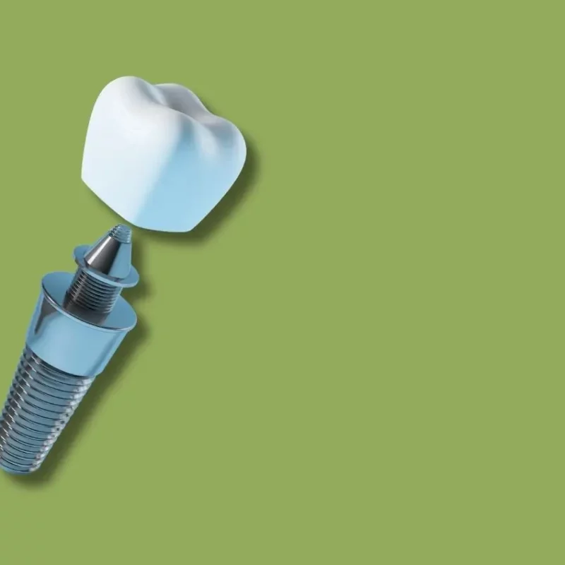 Implante inmediato tras extracción en Kimo en Valencia