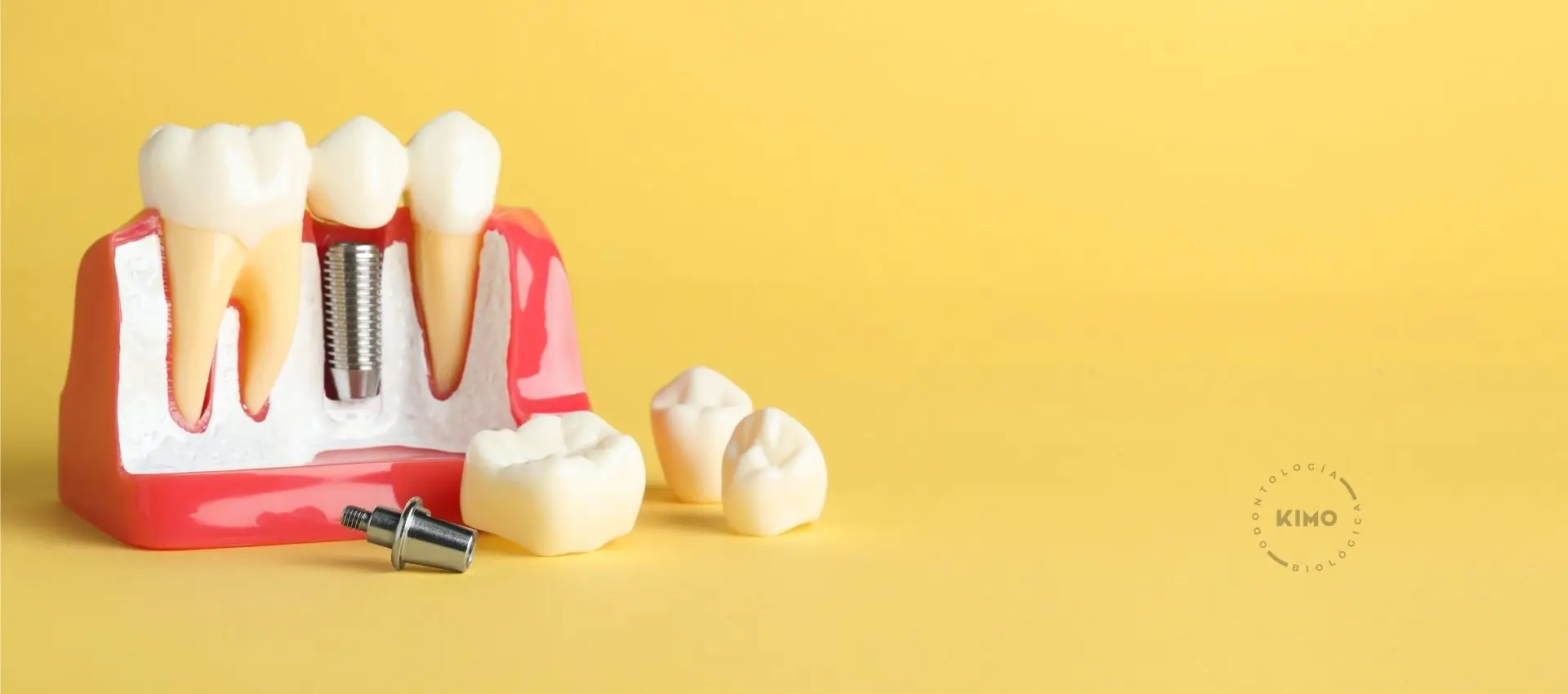 Implantes de carga inmediata en Valencia