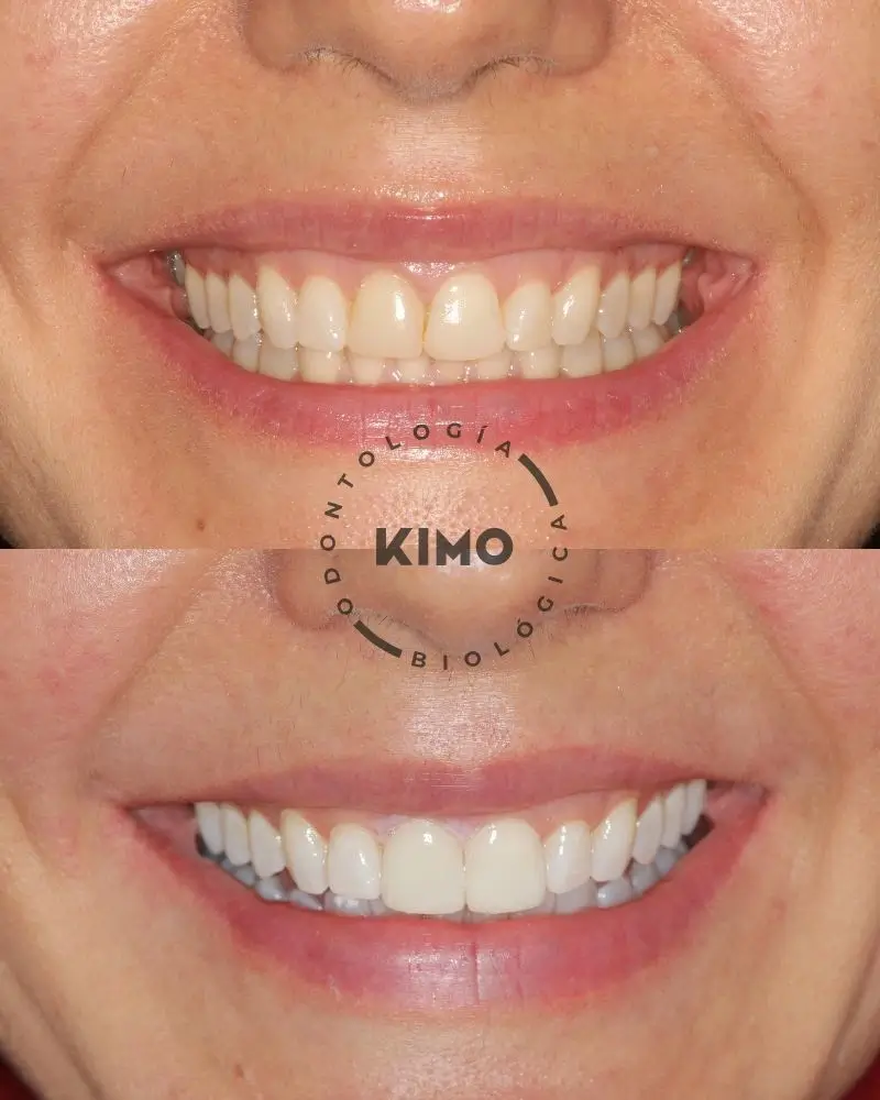 Antes y después de un blaqueamiento dental en KIMO Valencia