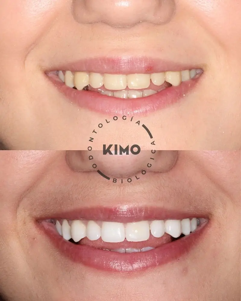 Antes y después caso de éxito de un tratamiento blanqueamiento slow en KIMO Valencia