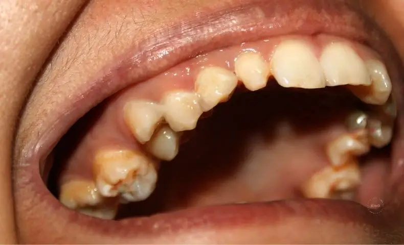 Dientes amarillos por café, té o tabaco