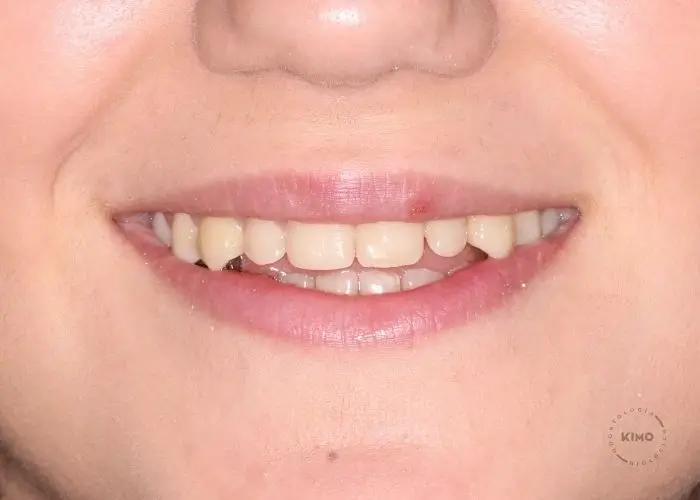 Dientes amarillos por café, té o tabaco