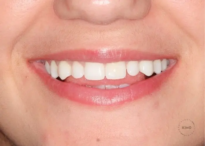 Dientes blancos después del tratamiento en KIMO
