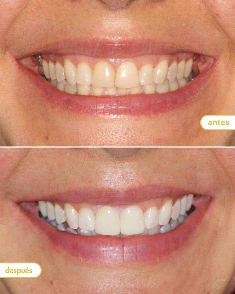 Antes y después de colocar carillas dentales en KIMO Valencia