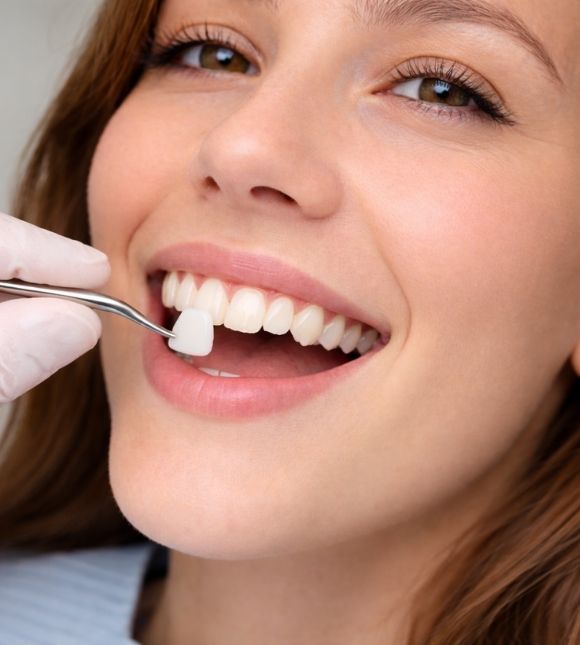 Colocación de carillas dentales en Valencia clínica KIMO