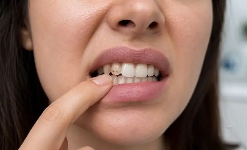 Manchas en los dientes que no se quitan con blanqueamiento