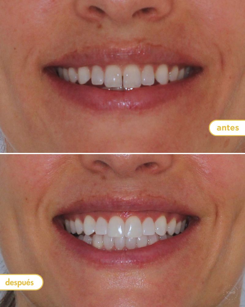 Antes y después de blanqueamiento dental y carillas en Kimo Valencia