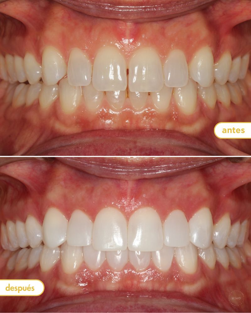 Intraoral antes y después de tratamiento de blanqueamiento dental y carillas en Valencia